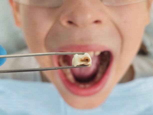 Best Emergency Dental Care for Broken or Chipped Teeth in Homosassa Springs, FL